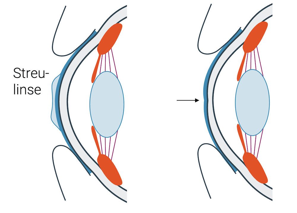 Kurzsichtigkeit Korrektur mit Kontaktlinse
