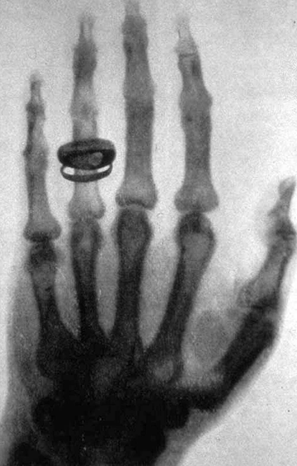 Röntgens erstes Röntgenbild