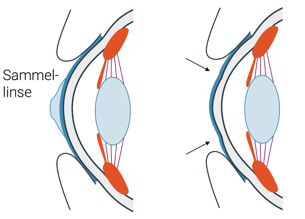 Weitsichtigkeit Korrektur mit Kontaktlinse